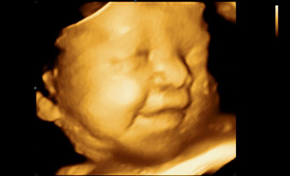 3D Ultrasound & 4D Ultrasound Packages, Orlando, FL